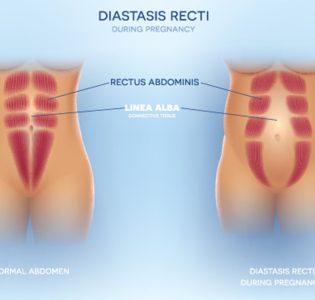 Diastasis Recti during pregnancy